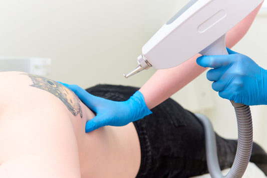 Laser Tattoo Removal Las Vegas: Safety Must-Knows