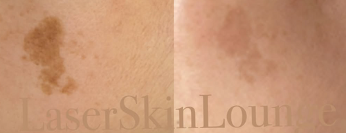 Pigmented Lesions, Sun Spot and Age Spot Removal